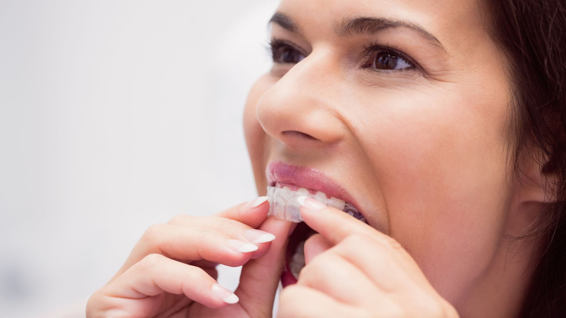 Invisalign Santa Clarita